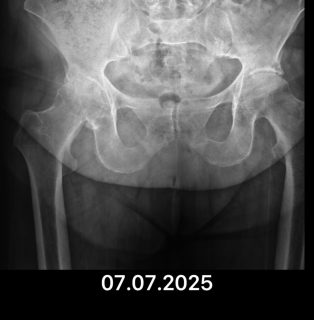 🦴 Total Kalça Protezi Nedir?

Total kalça protezi; kalça ekleminde ileri derecede kireçlenme, ağrı ve hareket kısıtlılığı olan hastalarda, hasarlı eklemin yapay eklemle değiştirilmesi işlemidir.

🔹 Kimlerde uygulanır?
✔️ İleri evre kalça kireçlenmesi
✔️ Kalça kırıkları
✔️ Romatizmal hastalıklar
✔️ Doğuştan kalça problemleri
✔️ Günlük yaşamı etkileyen şiddetli ağrı ve yürüme zorluğu

🔹 Ameliyatın amacı nedir?
➡️ Ağrıyı azaltmak
➡️ Hareket kabiliyetini artırmak
➡️ Hastanın günlük yaşama bağımsız şekilde dönmesini sağlamak

🔹 Ameliyat sonrası
🟢 Çoğu hasta kısa sürede ayağa kaldırılır
🟢 Fizik tedavi ile hızlı toparlanma hedeflenir
🟢 Doğru hasta seçimi ve uygun cerrahi teknikle yüz güldürücü sonuçlar alınır

Unutmayın: Her hasta özeldir. Tedavi planı mutlaka muayene ve görüntüleme sonrası kişiye özel yapılmalıdır.

Tüm hastalarımıza şifalar dilerim. Görüntüler yalnızca bilgilendirme amaçlıdır. Sonuçlar hastadan hastaya değişebilir. Tanı ve tedavi için mutlaka doktorunuza başvurunuz.