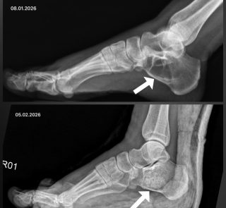 🦴 Kemik İçinde Yağ Dokusu (İntraosseöz Lipom) Nedir?

Bazı hastalarda kemiklerin iç kısmında, normal yağ dokusundan oluşan iyi huylu (kanser olmayan) bir kitle gelişebilir.
Buna intraosseöz lipom adı verilir.

📌 Önemli:
Bu durum tümör kelimesi geçse bile genellikle iyi huyludur ve çoğu zaman kansere dönüşmez

❓ Hangi Şikâyetlere Yol Açar?
	•	Uzun süredir devam eden lokal ağrı
	•	Yük verirken artan rahatsızlık
	•	Tesadüfen çekilen röntgen veya MR’da saptanması
	•	Nadiren kemikte zayıflama ve kırık riski

Her hasta ağrı hissetmeyebilir; bazı hastalarda tamamen tesadüfen ortaya çıkar.

🩺 Tedavi Nasıl Yapılır?

Belirgin ağrıya neden olan, büyüme gösteren ya da kemiği zayıflatan durumlarda cerrahi tedavi tercih edilir.

Bu hastamızda uyguladığımız yöntem:

🔹 Küretaj:
Kemik içindeki anormal yağ dokusu tamamen temizlenir.

🔹 Greftleme:
Temizlenen boşluk, kemiğin tekrar güçlenmesi için kemik grefti ile doldurulur.

Bu sayede:
	•	Kemik dayanıklılığı artar
	•	Ağrı azalır
	•	Kırık riski düşer

⏳ Ameliyat Sonrası Süreç
	•	Genellikle kısa hastanede kalış süresi
	•	Kontrollü yük verme
	•	Düzenli radyolojik takip
	•	Zamanla greftin kemikle bütünleşmesi

Çoğu hasta günlük hayatına kademeli olarak geri döner.

✅ Sonuç

✔️ İntraosseöz lipom iyi huylu bir durumdur
✔️ Gerekli hastalarda cerrahiyle başarılı şekilde tedavi edilebilir
✔️ Erken tanı ve doğru tedavi ile uzun dönem sonuçlar yüz güldürücüdür

Unutmayın: Her hasta özeldir. Tedavi planı mutlaka muayene ve görüntüleme sonrası kişiye özel yapılmalıdır.

Tüm hastalarımıza şifalar dilerim. Görüntüler yalnızca bilgilendirme amaçlıdır. Sonuçlar hastadan hastaya değişebilir. Tanı ve tedavi için mutlaka doktorunuza başvurunuz.
