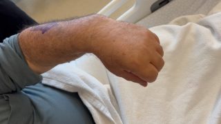 İlk video: 19.02.2026
Son video: 23.03.2026

PIN (Posterior Interosseöz Sinir) Yaralanmasında Tendon Transferi

8 yıllık sinir hasarı sonrası parmak ve başparmak hareketi geri kazanılabilir mi? Evet tendon transferi ile kazanılabilir.

Parmaklarını ve başparmağını 8 senedir kaldıramayan hastamız tendon transferi ile fonksiyonlarını yeniden kazandı.

Posterior interosseöz sinir (PIN) yaralanmalarında hastalar genellikle:
❌ Parmaklarını açamaz
❌ Başparmağını yukarı kaldıramaz
❌ El bileği hareketi kısmen korunabilir

Bu durum, özellikle günlük yaşamda ciddi fonksiyon kaybına yol açar.

🔄 Geç Dönem Hastalarda Çözüm: Tendon Transferi

Çalışan kasların tendonları, çalışmayan kasların görevini üstlenecek şekilde yeniden yönlendirilir.

✔️ FCR → EDC
➡️ Parmak açma sağlanır

✔️ PL → EPL
➡️ Başparmak kaldırma (retropulsiyon) geri kazandırılır

⚙️ Amaç Nedir?

🎯 Aktif parmak ekstansiyonu
🎯 Başparmak fonksiyonunun geri kazanılması
🎯 Günlük yaşam aktivitelerinde bağımsızlık

📌 Doğru hasta seçimi + uygun cerrahi teknik ile  sonuçlar yüz güldürücüdür.

➡️ Çoğu hastada anlamlı fonksiyonel iyileşme mümkündür.

Unutmayın: Her hasta özeldir. Tedavi planı mutlaka muayene ve görüntüleme sonrası kişiye özel yapılmalıdır.

Tüm hastalarımıza şifalar dilerim. Görüntüler yalnızca bilgilendirme amaçlıdır. Sonuçlar hastadan hastaya değişebilir. Tanı ve tedavi için mutlaka doktorunuza başvurunuz.