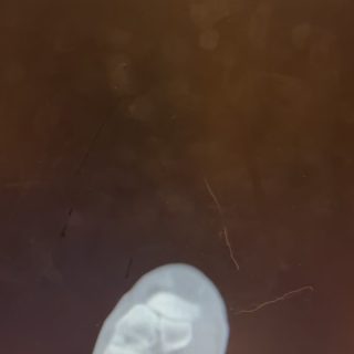 BT tarihi: 23.01.2026
Röntgen tarihi: 24.01.2026

Trimalleolar kırık, ayak bileğinde üç bölgenin birden kırılmasıdır:
	•	İç çıkıntı (medial malleol)
	•	Dış çıkıntı (lateral malleol)
	•	Arka malleol (tibia arka kenarı)

Bu tip kırıklar genellikle yüksek enerjili burkulma, düşme veya trafik kazası sonrası oluşur ve ayak bileğinde ciddi instabiliteye yol açar.

🔎 Belirtiler
	•	Şiddetli ağrı
	•	Hızla artan şişlik ve morarma
	•	Üzerine basamama
	•	Şekil bozukluğu

🩺 Tanı Nasıl Konur?
	•	Direkt grafi (röntgen) ile kırıklar görülür.
	•	Gerekirse BT (Bilgisayarlı Tomografi) ile arka malleol ve eklem yüzü detaylı değerlendirilir.

🔧 Tedavi

Trimalleolar kırıkların büyük çoğunluğu cerrahi gerektirir.
Amaç:
✔️ Eklem yüzünü anatomik olarak düzeltmek
✔️ Plak–vida ile stabil tespit sağlamak
✔️ Erken dönemde kontrollü hareket başlatmak

Cerrahi sonrası genellikle:
	•	4–6 hafta yük vermeme
	•	Kontrollü fizik tedavi
	•	Ortalama 3 ayda günlük hayata dönüş

⚠️ Tedavi Edilmezse?
	•	Kalıcı instabilite
	•	Posttravmatik kireçlenme
	•	Kronik ağrı
	•	Yürüme bozukluğu gelişebilir.

💬 Önemli Not

Ayak bileği kırıkları “sadece burkulma” sanılabilir.
Şiddetli ağrı ve basamama varsa mutlaka ortopedi değerlendirmesi gerekir.

Unutmayın: Her hasta özeldir. Tedavi planı mutlaka muayene ve görüntüleme sonrası kişiye özel yapılmalıdır.

Tüm hastalarımıza şifalar dilerim. Görüntüler yalnızca bilgilendirme amaçlıdır. Sonuçlar hastadan hastaya değişebilir. Tanı ve tedavi için mutlaka doktorunuza başvurunuz.